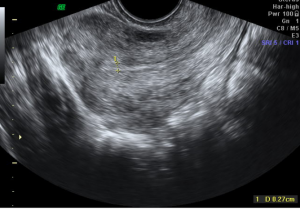אולטרסאונד אנדומטריוזיס